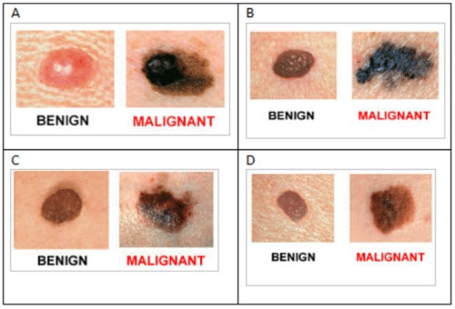 SkinCancer ABCD